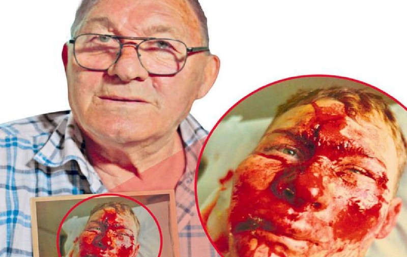 Dragoș Panaitescu, olimpicul român căruia medicii i-au reconstruit fața, după ce a suferit un grav accident la bob: „A cerut poza mea. M-a operat pe pârtie. Capul fusese frână”