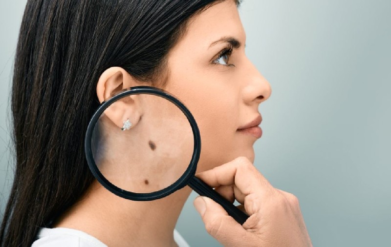 Greșelile uriașe pe care le fac românii cu alunițele. Unde poți face consultații dermatologice gratuite