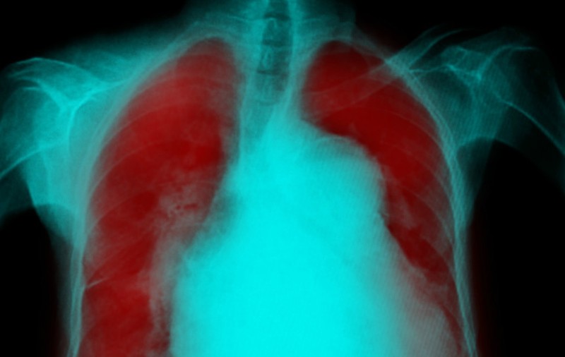 Cum să combaţi eficient pneumonia