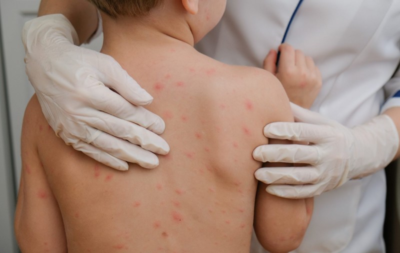 Două noi decese în România din cauza rujeolei: un copil de 7 luni și un adult de 35 de ani, ambii nevaccinați