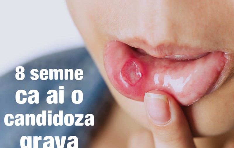 Semne că infecția cauzată de candida îți distruge organismul