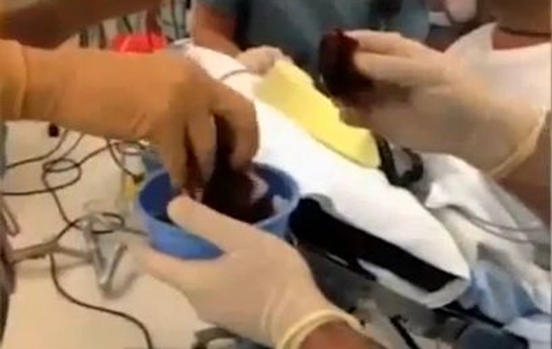 CULMEA CHIRURGIEI! Pacientul care CÂNTĂ LA CHITARĂ ÎN TIMP CE ESTE OPERAT PE CREIER | FOTO şi VIDEO