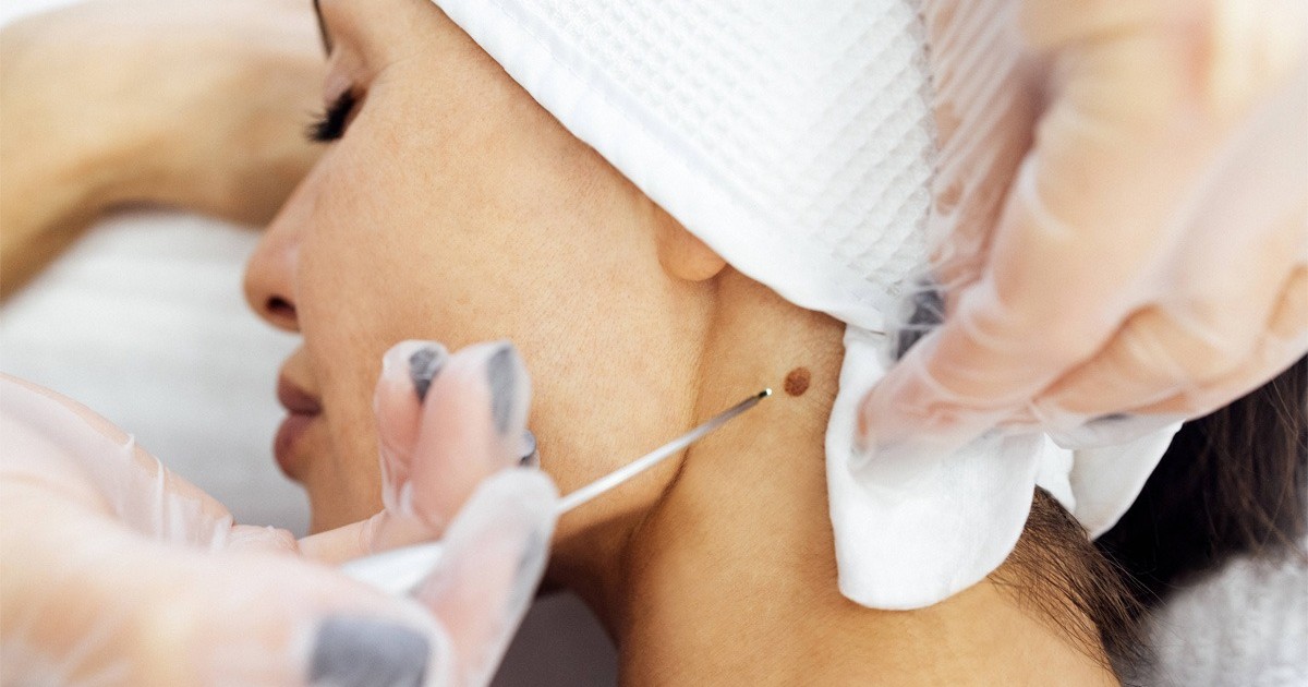 O femeie care sta intinsa pe un pat, la gat are o alunita, iar o mana cu manusa chirurgicala intinde o pensa spre alunita. De ce sa scoti iarna alunitele,Explicatii dr. Raluca Radu medic dermatolog. Foto Imago