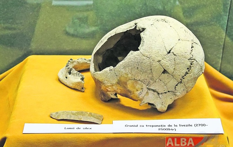 Operaţii pe creier acum 4.500 de ani, la Alba