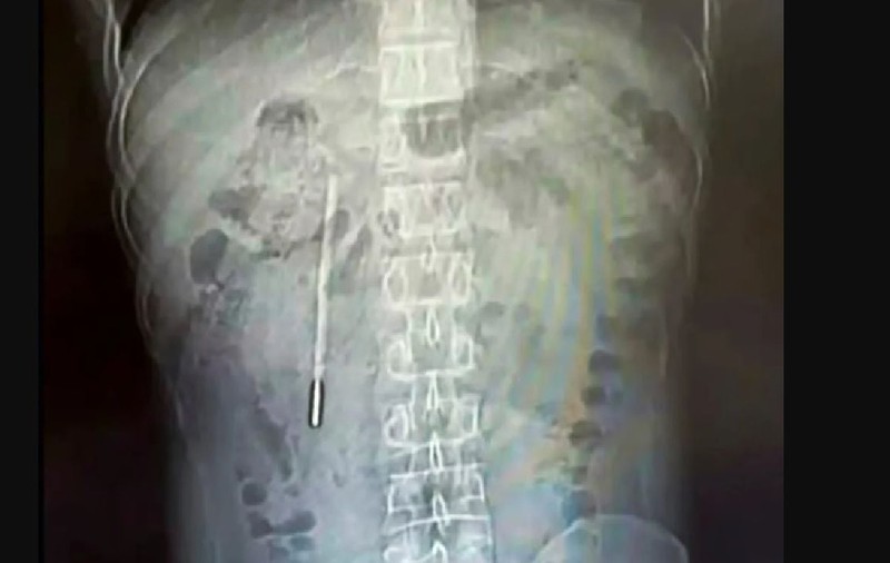 Medici șocați de ce au descoperit în stomacul unui bărbat internat cu dureri abdominale groaznice, în China: „Era acolo de 20 de ani”