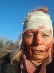 Olena Kurilo, 52 de ani,&nbsp;o supraviețuitoare a atacului rusesc cu rachete, Chuhuev, regiunea Harkov. Femeia a devenit una dintre imaginile războiului. A fost acuzată de propaganda rusă că și-a înscenat rănile. Într-un interviu acordat Libertatea, ea a vorbit despre atacul care i-a vizat locuința și și-a arătat rănile.