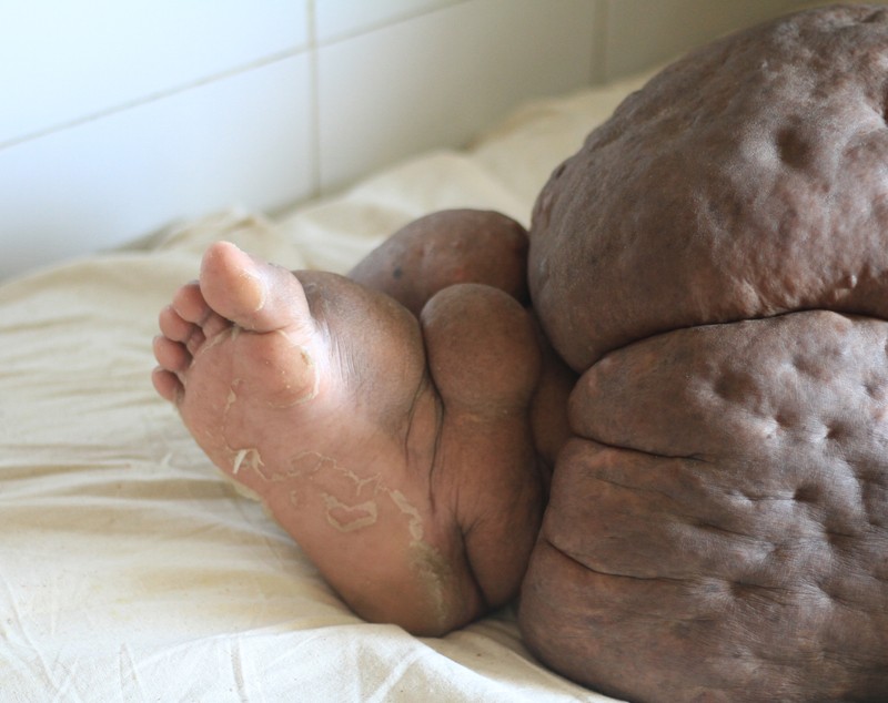 FOTO | Drama unei femei bolnave de elefantiazis. Piciorul ei a ajuns să cântărească 60 de kilograme