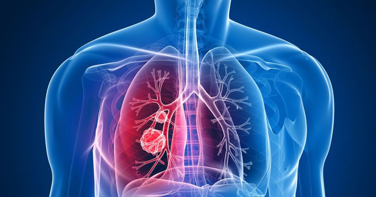Simptomele cancerului pulmonar