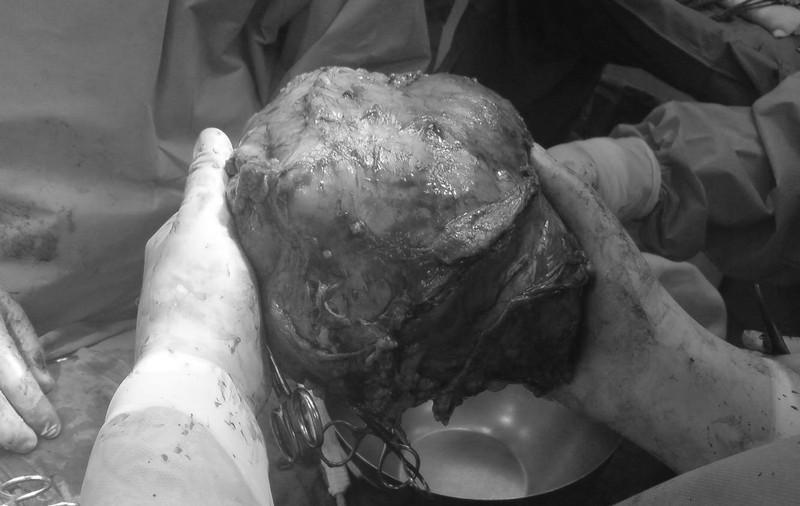 CEA MAI MARE TUMORĂ din LUME! O femeie din INDIA A fost OPERATĂ de UN FIBROM ce cântărea 13 KILOGRAME! VIDEO ÎNGROZITOR