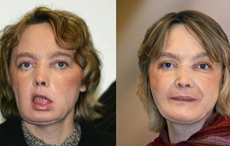 Femeia cu transplant de faţă nu se simte în pielea ei