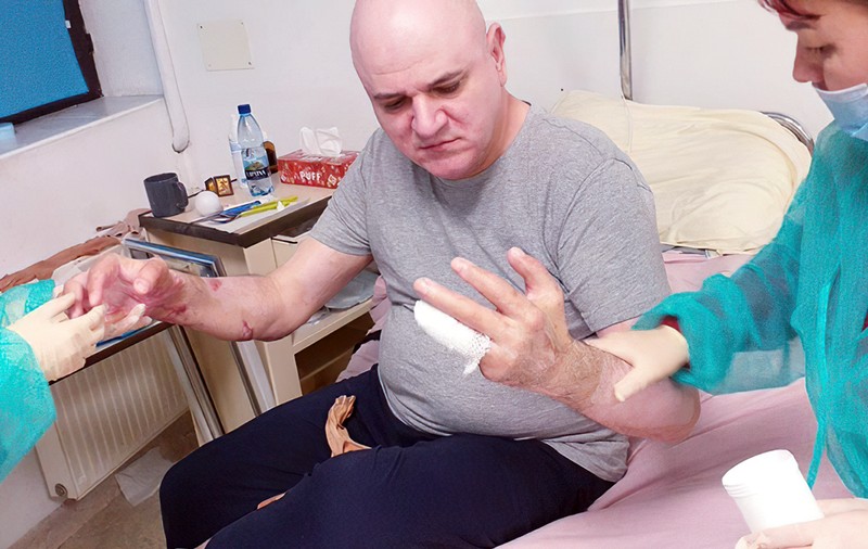 Pompierul Mihai Sfetcu a devenit primul mare ars din România căruia statul îi va plăti integral tratamentul de recuperare medicală  în străinătate