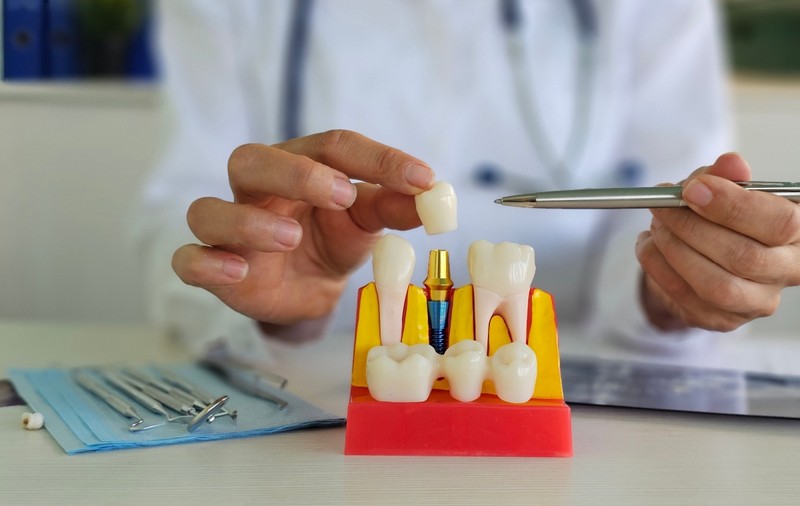 6 avantaje ale implantului dentar