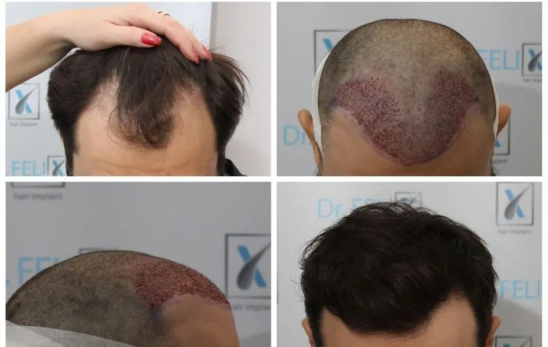 Ghid complet pentru îngrijirea părului după implant: Sfaturi și trucuri