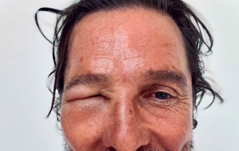 Matthew McConaughey și-a îngrijorat fanii după ce a apărut cu ochiul umflat. Ce a pățit actorul
