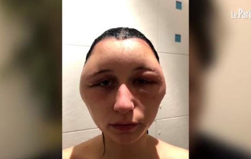 O tânără din Franța a fost desfigurată de un produs banal. Aproape toate femeile îl folosesc