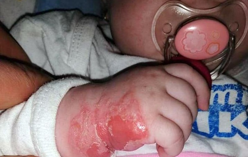 Imagini șocante cu rănile suferite de un bebeluș internat în spital. Mama fetiței, la Adriana Nedelea LA FIX: „Femeia de serviciu i-a scos branula copilașului”