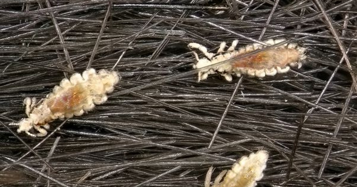 Pediculoză infestarea cu păduchi