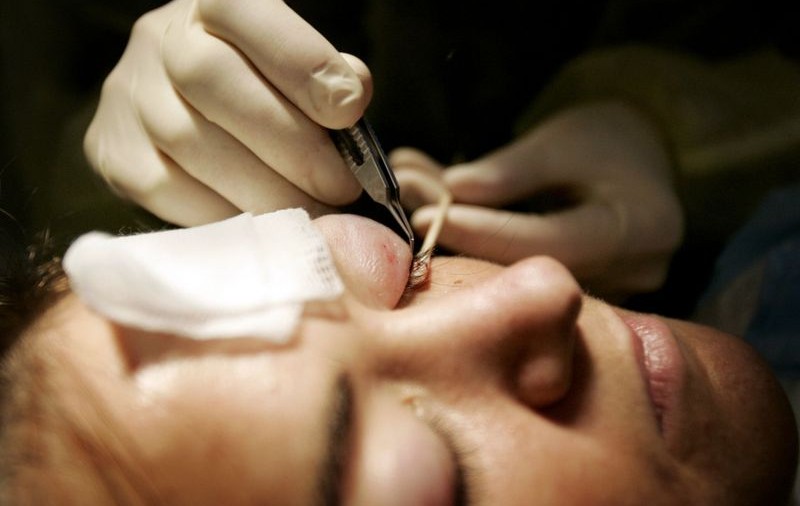 Implant de gene, pentru o tânără care-şi smulge părul
