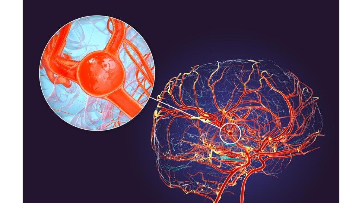 foto: angiografie cerebrala