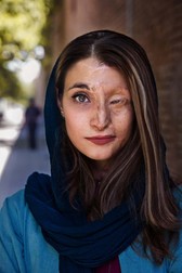 Marzieh, din Isfahan, Iran. În timp ce se afla în trafic, la un semafor, doi bărbați pe o motocicletă au stropit-o cu acid. Au mai avut loc atacuri asemănătoare împotriva femeilor care nu purtau hijabul. Foto: Mihaela Noroc / Atlasul frumuseții