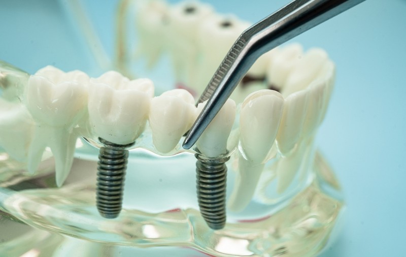 Avantajele implanturilor dentare: O soluție durabilă pentru un zâmbet sănătos
