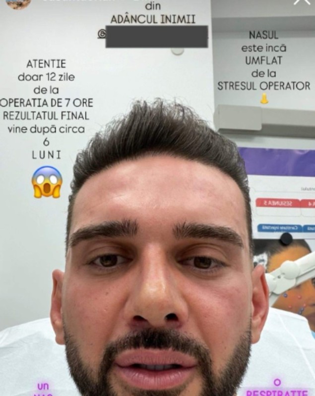 Cum arată nasul lui Dorian Popa la 12 zile de la operație. Și-a dat bandajul jos: „Cum nici nu am visat”