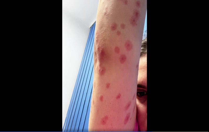 O studentă cazată într-un cămin din Regie a ajuns la spital cu zeci de înţepături pe corp: „Că-s nespălate şi vin de la ţară cu ploşniţele în raniţe”