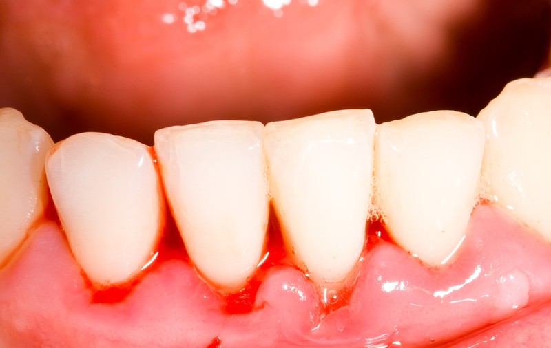 Află ingredientul secret care îți menține gingiile sănătoase