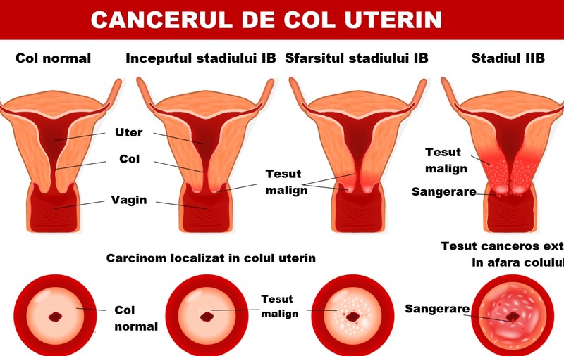 Cauzele apariţiei cancerului de col uterin