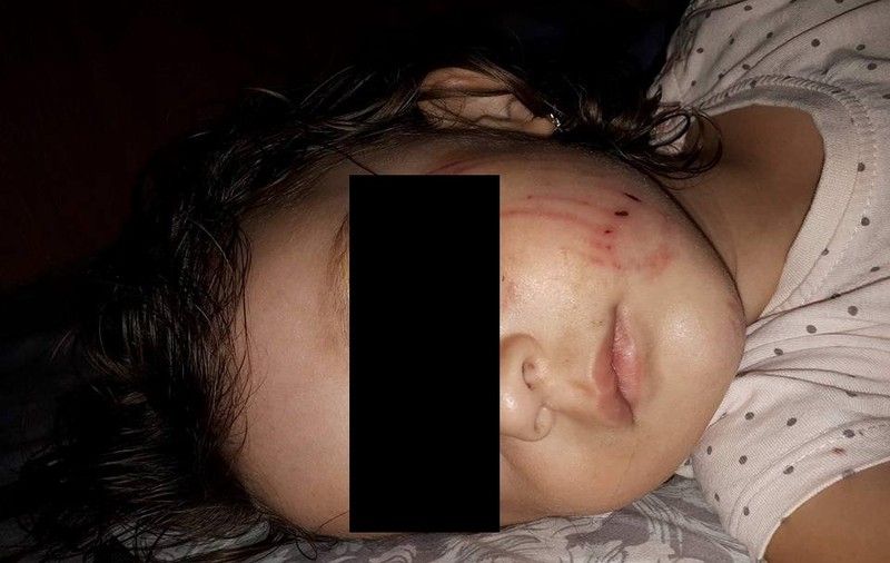 Fetiţă de doi ani atacată de un câine într-un parc din Buzău. Imaginea copilei pline de zgârieturi a devenit virală|FOTO