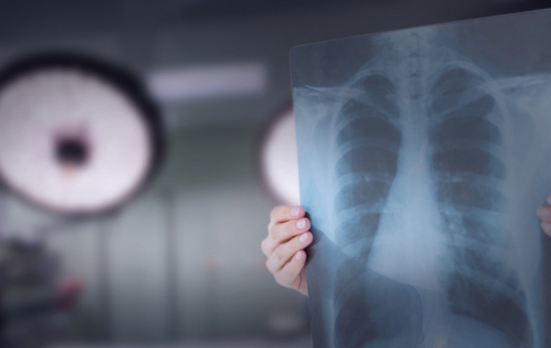 O femeie a fost operată de cancer pulmonar, deși era sănătoasă: „Diagnosticul de tumoră a fost stabilit în mod pripit”