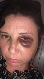 Atacul violent a lăsat-o pe Jemma cu o falcă fracturată și doi ochi negri (foto Jemma Palmer)
