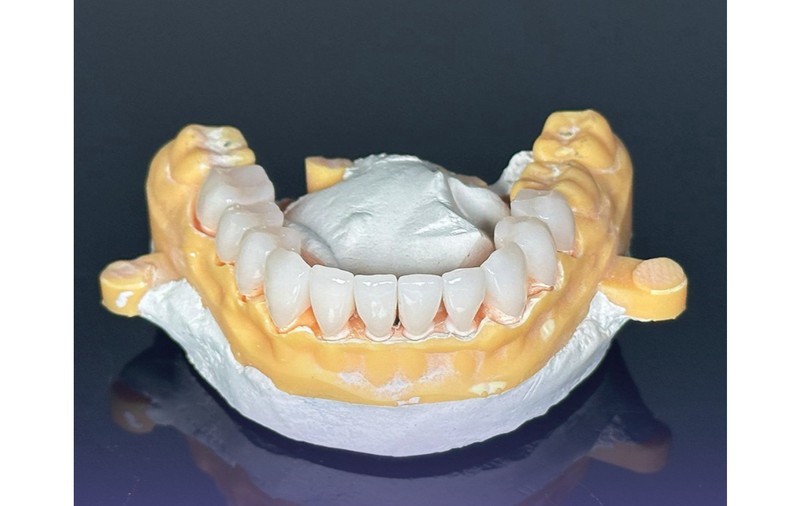 Implant dentar într-o zi? Află dacă ești candidatul ideal