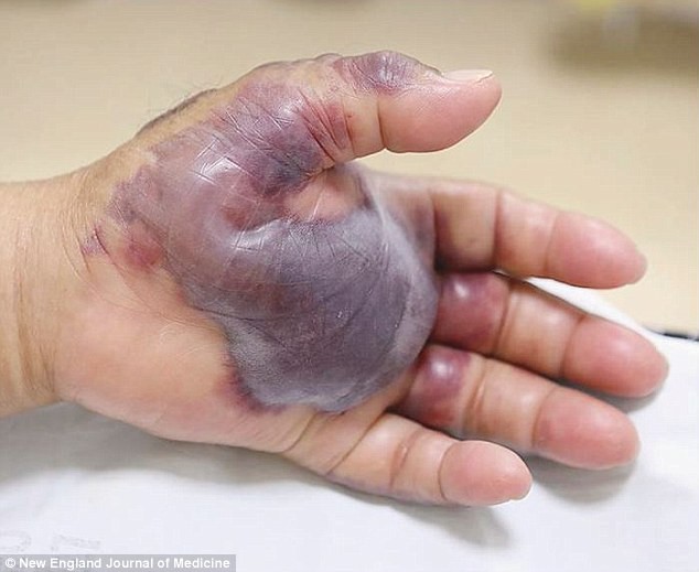 Mâna necrozată a sud-coreeanului care a mâncat sushi / FOTO: New England Journal of Medicine