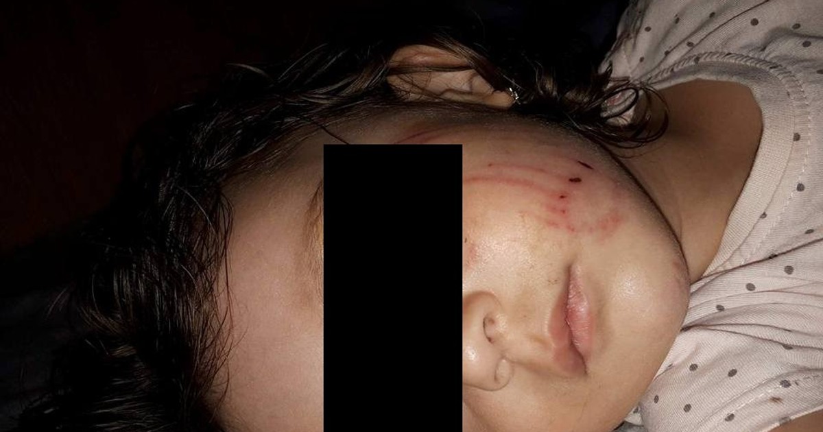 Fetiță atacată de un câine la Buzău