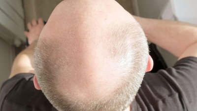 chelie-tratament-alopecie