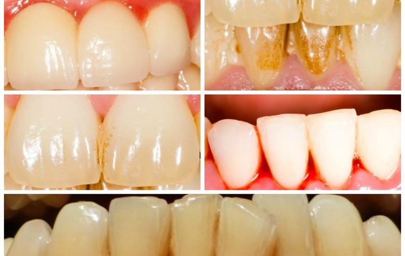 7 probleme dentare şi simptomele lor