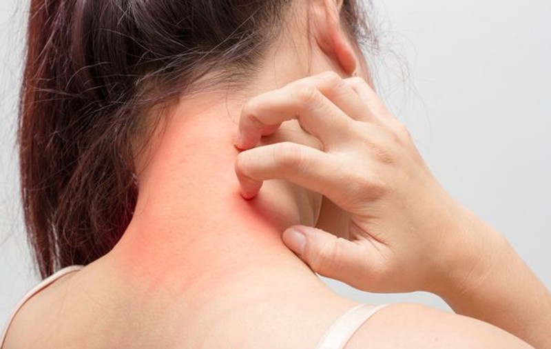 Ai grijă ce bijuterii porți dacă ai dermatită de contact