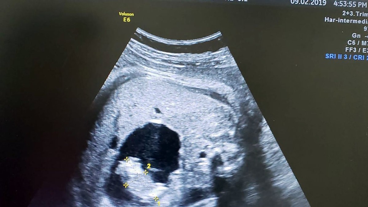 Ecografie fetus-in-fetu