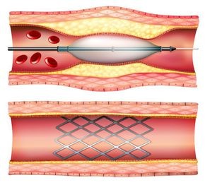 Stent la inimă