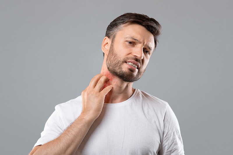 Urticaria, o reacție alergică foarte frecventă. Foto ilustrativ: Shutterstock