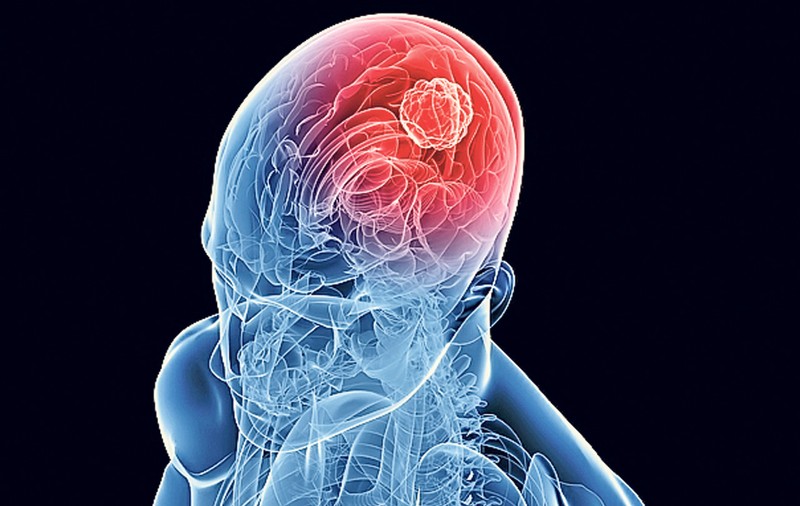 Ai studii superioare? Eşti predispus la atac cerebral