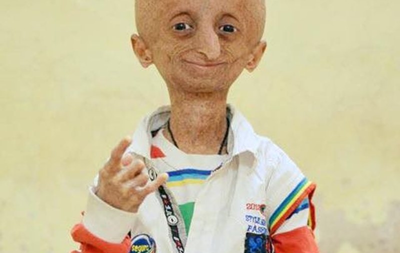 Băieţelul care suferă de "boala lui Benjamin Button" i-a uimit pe medici. Are 15 ani, dar arată de 80