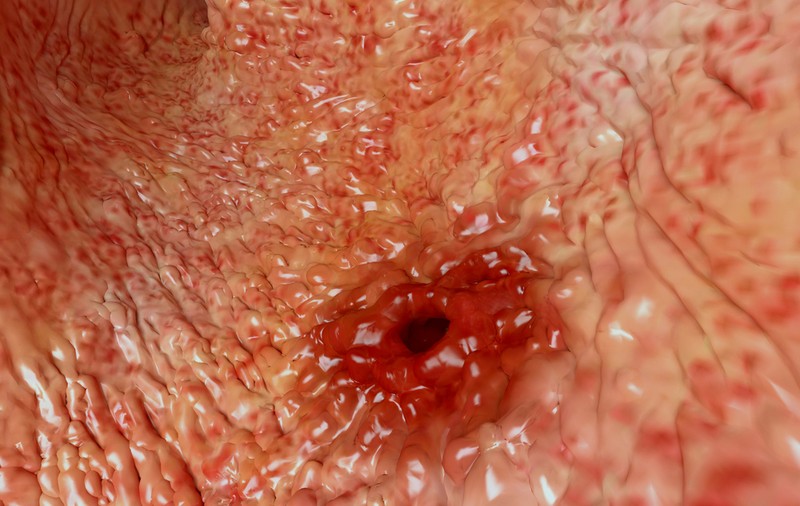 Care este medicamentul care provoacă ulcer şi gastrită