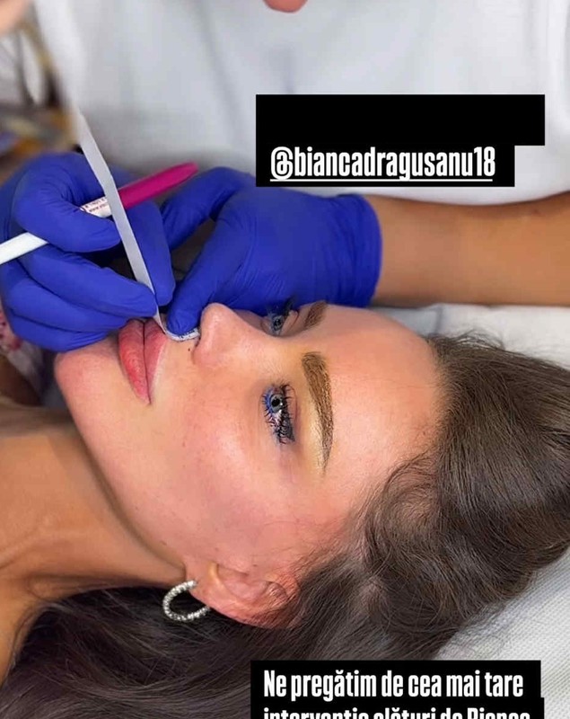 Bianca Drăgușanu și-a făcut o nouă operație estetică la față. Cât costă procedura chirurgicală care e gata în 30 de minute: „Va fi wow”