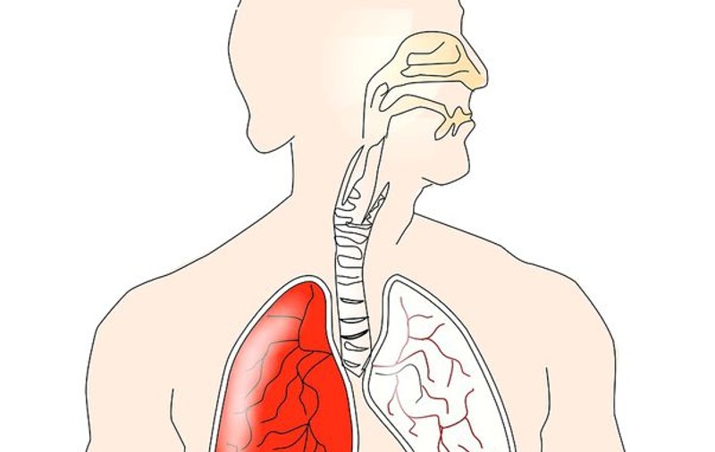 Cancerul la plămâni (cancerul pulmonar)