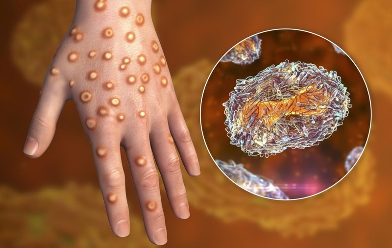 Primul caz de infectare cu noua variantă a virusului mpox, variola maimuței, confirmat în Germania