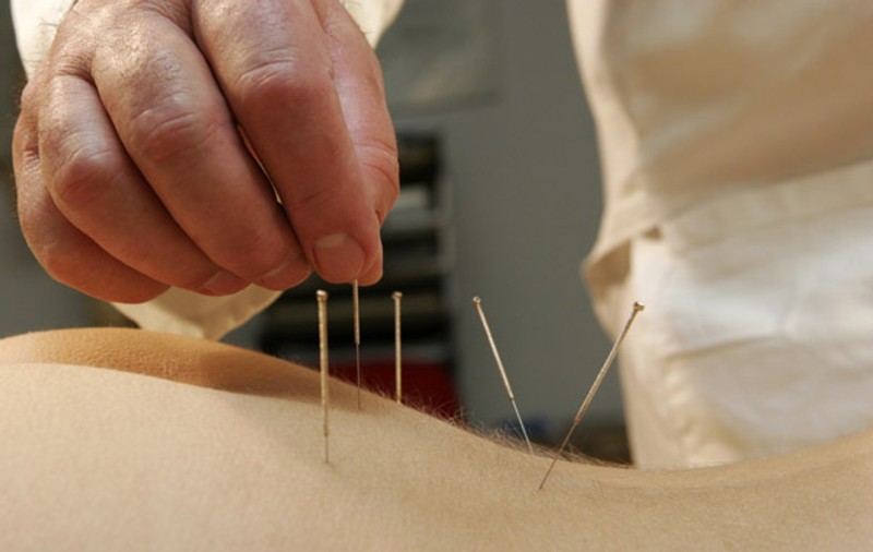 Cele mai noi metode de acupunctură | Vezi ce dureri alină această metodă de tratament!