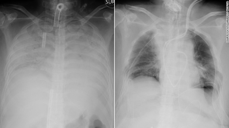 Radiografiile cu plămânii pacientei, înainte (stânga) și după (dreapta) operație. Zonele mai închise la culoare din dreapta sunt cele unde a fost transplantat țesut pulmonar