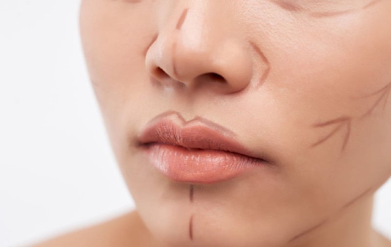 Colegiul Medicilor s-a autosesizat după ce o pacientă a murit în urma unui „mini-lifting facial”, efectuat într-o clinică din București